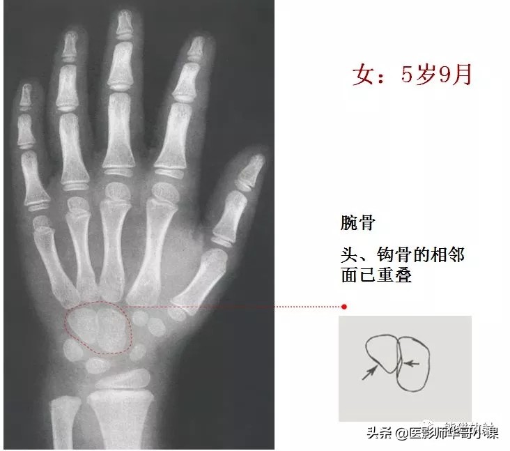 骨龄片对照图谱测骨龄准不,骨龄14岁男孩骨龄图谱