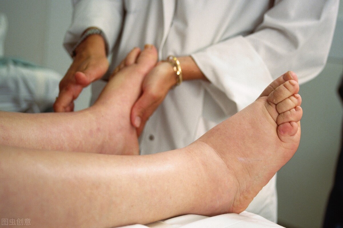 精神类药物导致水肿怎么办,精神病药会导致下肢浮肿吗