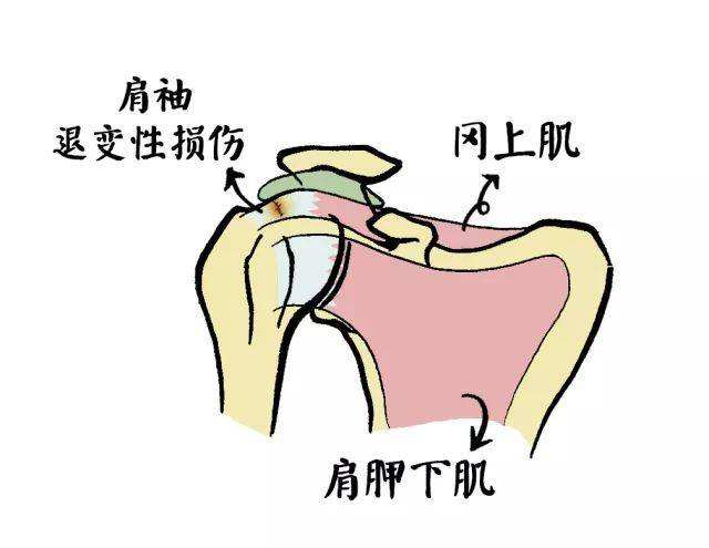 肩袖损伤不完全撕裂严重不严重,肩袖损伤不治疗得好吗