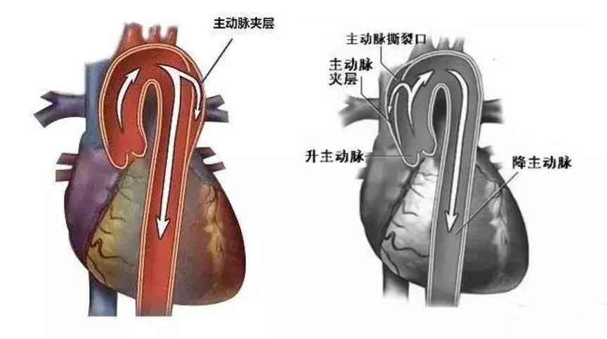 a型主动脉夹层,主动脉夹层撕裂