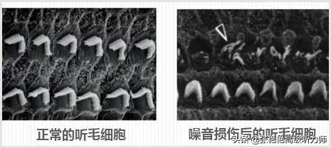 各种常见听力损失,哪种类型的听力损伤具有稳定性