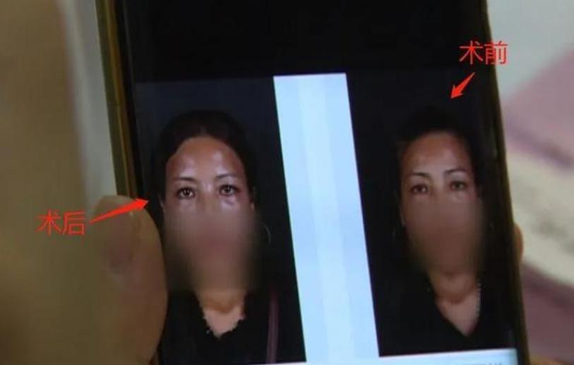 女子做完脸部填充,女子整容后发现一只眼睛无法闭上