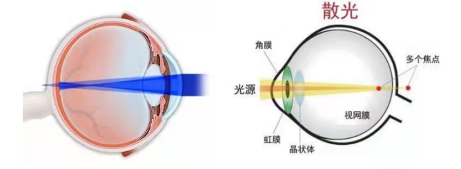 4岁孩子散光可以恢复吗,孩子有散光不戴眼镜可以恢复吗