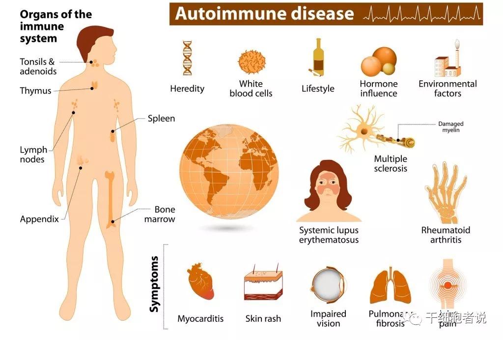 干细胞治疗红斑狼疮最新消息,干细胞治疗红斑狼疮临床研究