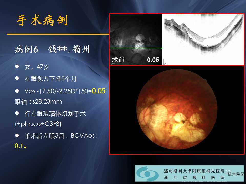 高度近视黄斑劈裂哪家医院好,高度近视黄斑劈裂中医治疗