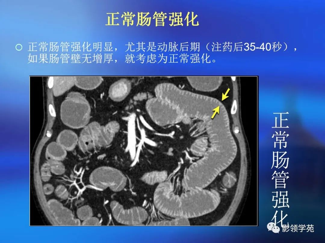 肠道内壁增厚,肠道扩张ct表现