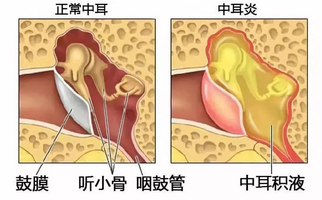 分泌性中耳炎原来是鼻子惹的祸,分泌性中耳炎是治鼻子还是耳朵
