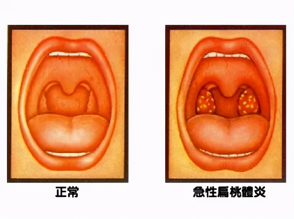 孩子扁桃体经常发炎，到底要不要切掉？