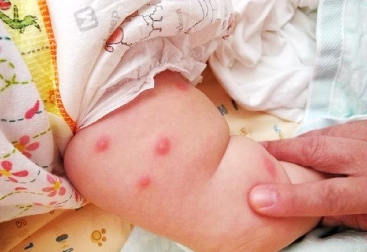 宝宝被蚊子叮咬后多久会好,婴儿经常被蚊子叮咬会有什么影响