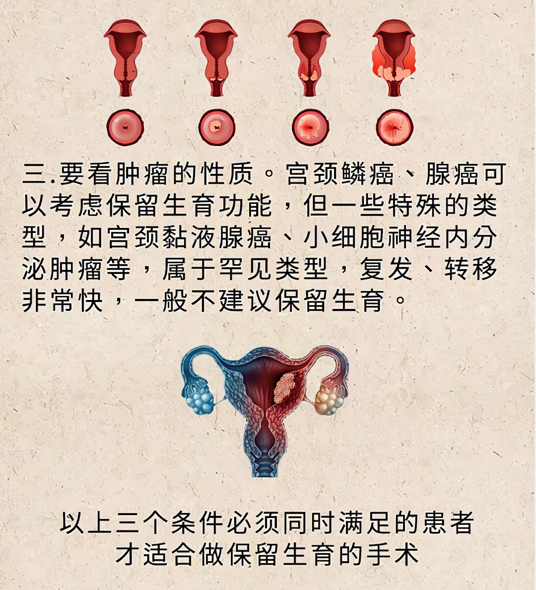 解决宫颈癌发生最好的治疗是什么,宫颈癌微创专家