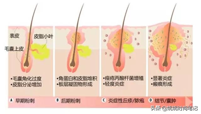 硫磺皂真的可以祛痘吗,硫磺皂真的能祛痘除螨吗