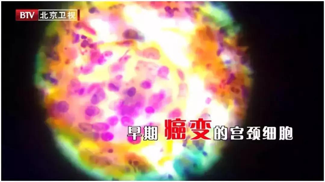 专家教你怎么预防宫颈癌,专家讲如何预防宫颈癌