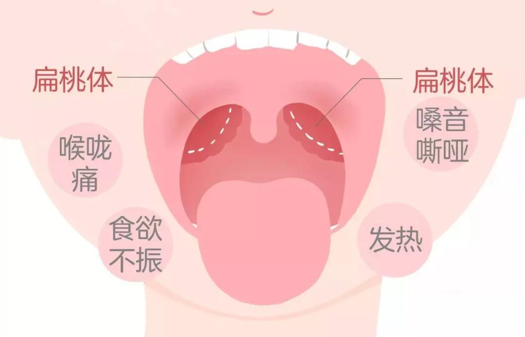上火引起的扁桃体发炎多久能好,上火引起的扁桃体发炎怎么办