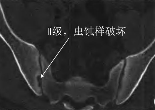 强直性脊柱炎骶髂关节二级改变,强直性骶髂关节炎等级