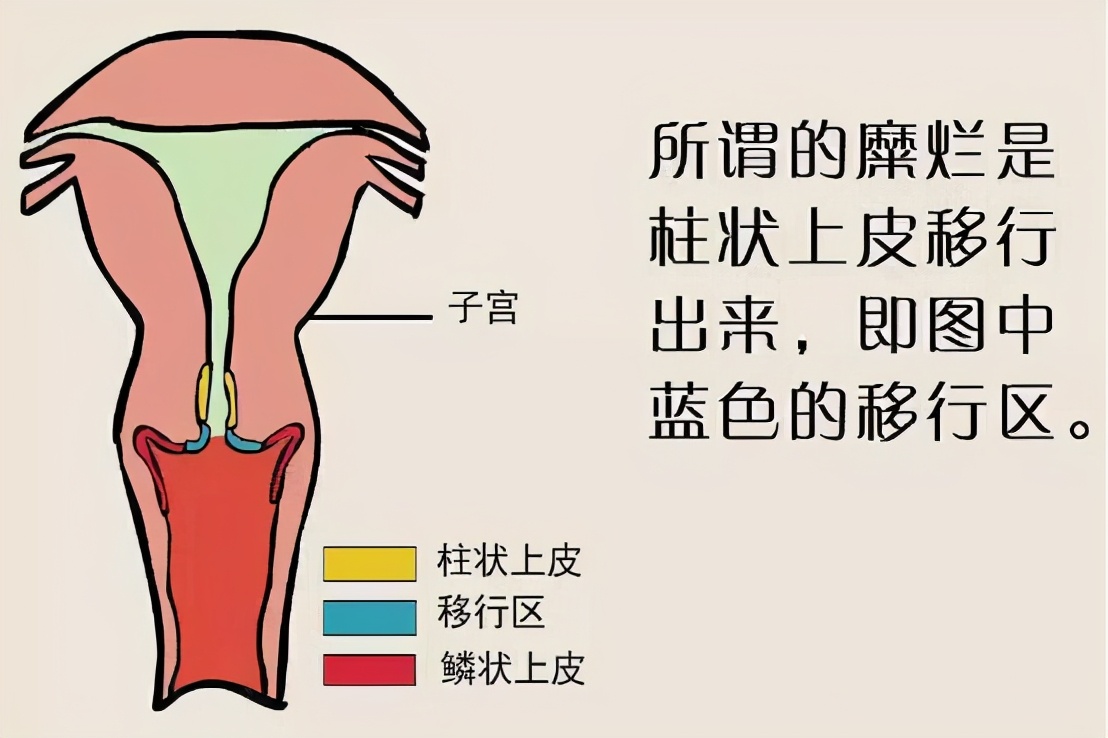 宫颈癌和宫颈糜烂症状一样不,宫颈糜烂与宫颈癌的症状区别