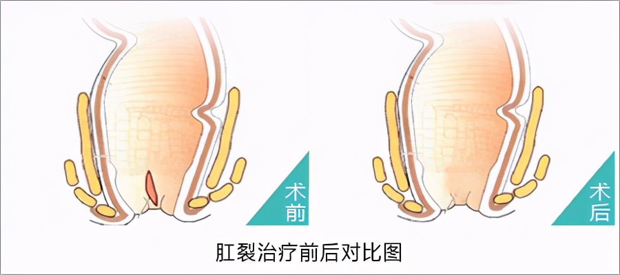 堪比生孩子的疼痛,号称比生孩子还疼的肛周脓肿手术