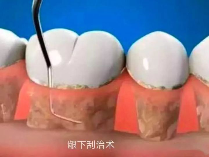 中国人老掉牙,中国人为什么老爱掉牙