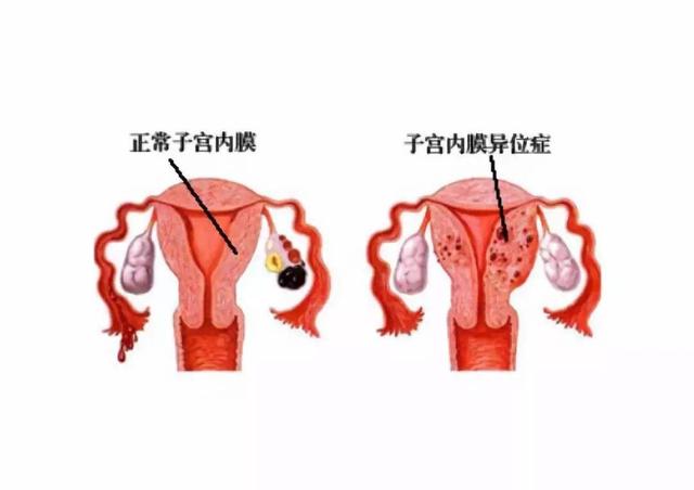 痛经是一种心理障碍吗,痛经特别严重可能是什么疾病