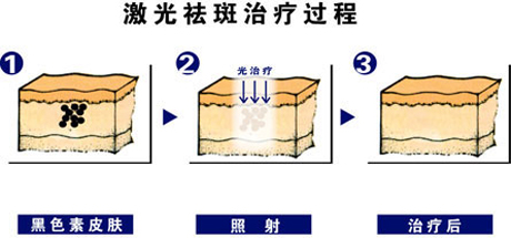 皮秒激光和普通激光怎么看出区别,皮秒激光就是镭射净肤吗