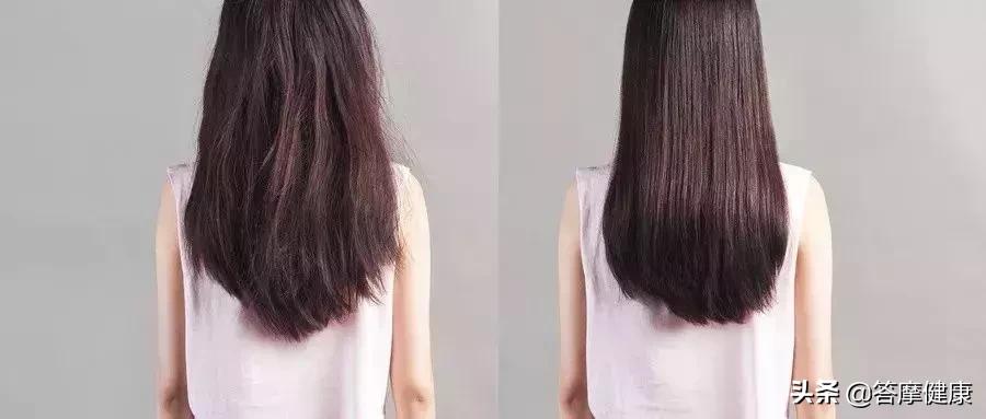 掉发头发少发际线高是什么原因,发际线起皮干燥有碎屑什么原因